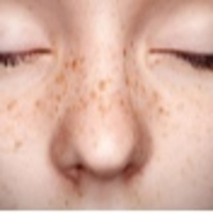 Facial Freckles